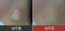 7岁挑食儿童遇见